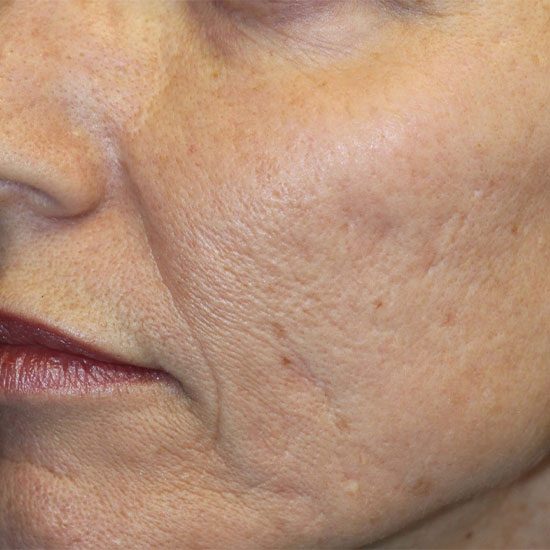 Dermapen πριν και μετα