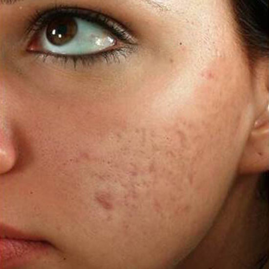 Dermapen πριν και μετα