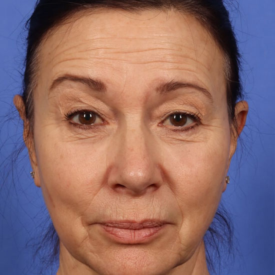 θεραπεια αντιγηρανσης hydrafacial πριν και μετα