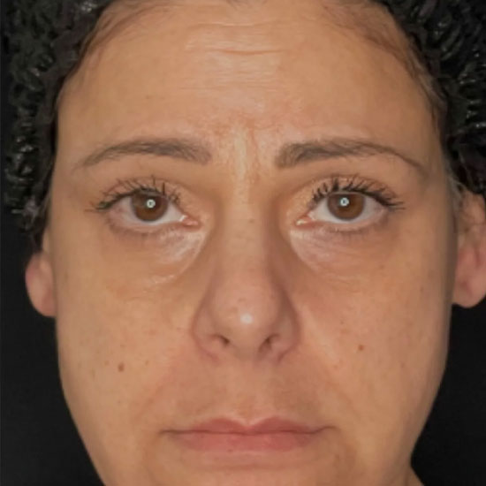 hydrafacial θεραπεια αντιγηρανσης πριν και μετα