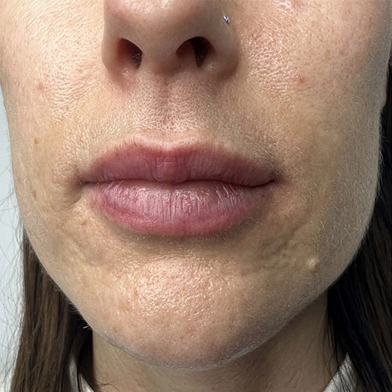 Fractional Laser Ανάπλαση Προσώπου πριν και μετα