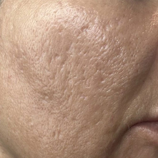 Fractional Laser Ανάπλαση Προσώπου πριν και μετα