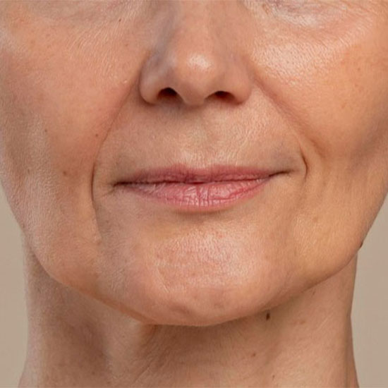 Botox - Λείανση Ρυτίδων πριν και μετα