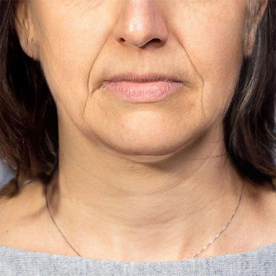 Botox - Λείανση Ρυτίδων πριν και μετα