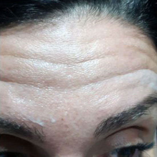 Botox - Λείανση Ρυτίδων πριν και μετα