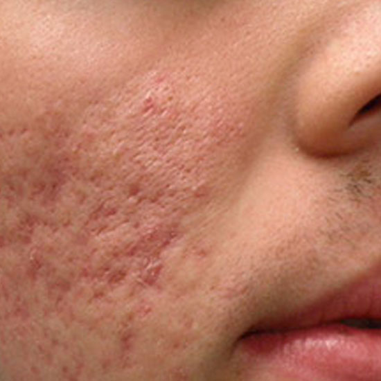 Fractional Laser Ανάπλαση Προσώπου πριν και μετα
